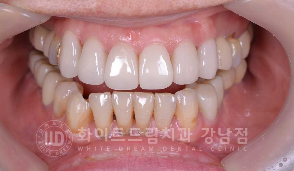 노화된 치아 라미네이트 / 치아미백을 해도 하얘지지 않는 마모된 치아는 어떻게 할까? 관련 이미지 15