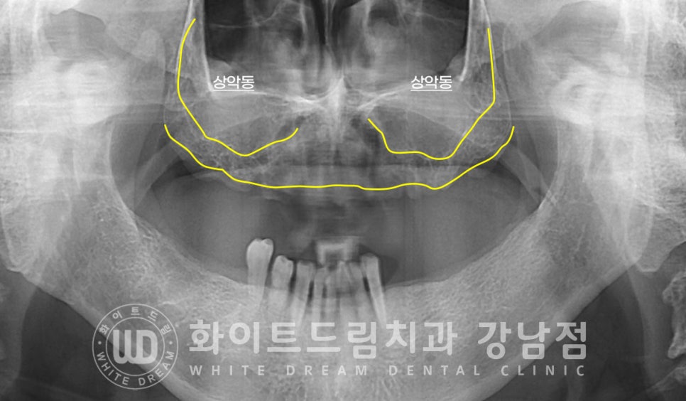 상악 풀케이스임플란트 사례 / "지인 추천으로 인천에서 왔어요." 관련 이미지 6