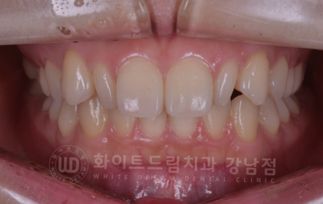 강남역 심미치과 "치아 하나가 유난히 작아요" #왜소치라미네이트 관련 이미지 4