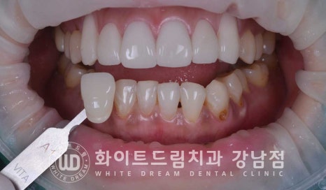 치경부착색 치료 / 라미네이트 vs 올세라믹 치아 삭제량 비교 (Feat. 라미네이트 후 치아미백 가능한가요?) 관련 이미지 17