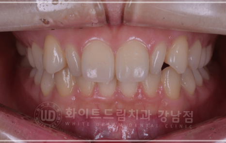 신논현역 라미네이트 / 과개교합 치아교정 + 왜소치 라미네이트 진행 case 관련 이미지 2