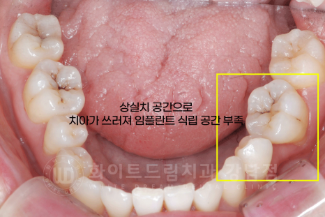 강남 덧니 비발치교정 / 임플란트와 치아교정 동시 진행 case 리뷰. 관련 이미지 11