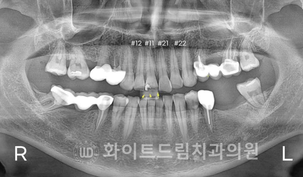 신논현역 당일 라미네이트, "길이가 다른 깨진 앞니" 당일 앞니 라미네이트 치료 과정은? 관련 이미지 6