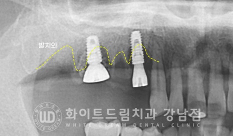 발치 즉시 임플란트 "내원 당일 발치 후 바로 임플란트 식립!" 관련 이미지 11