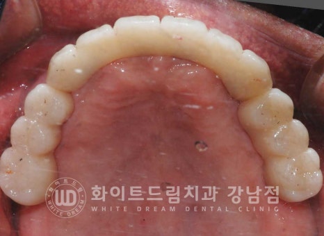 전체 임플란트 치료 기간과 내원 횟수는? "치과에 자주 가기 어려워요." 관련 이미지 24