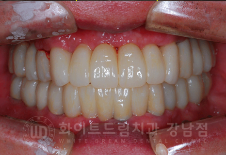강남역 전체임플란트 치과 "치아가 심하게 흔들려요." 심한 치주염 임플란트 치료 관련 이미지 16