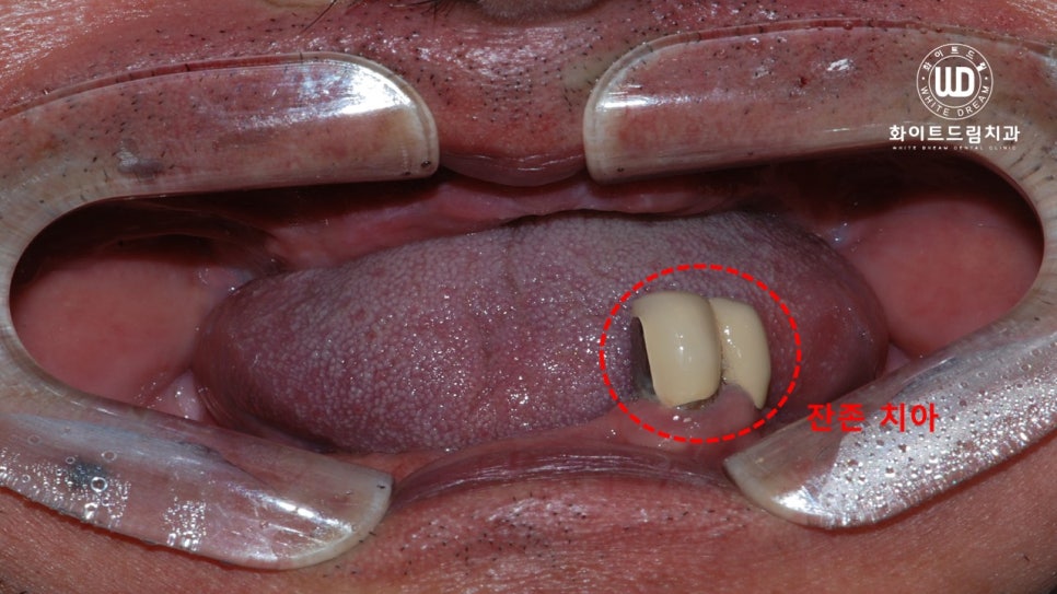 전체 치조골 이식을 동반한 고혈압 환자 임플란트 사례 관련 이미지 2