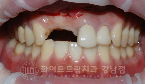 앞니 임플란트 사례 "예전에 심은 임플란트를 뺐어요. 재수술 가능할까요?" 관련 이미지 2