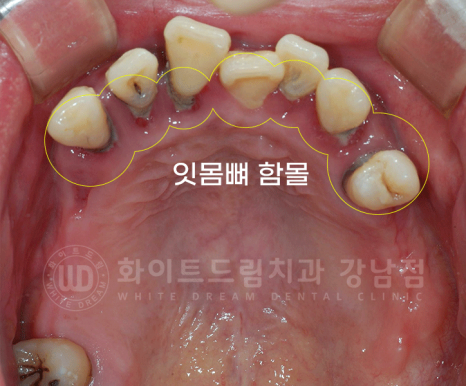 강남역 전체임플란트 치과 "치아가 심하게 흔들려요." 심한 치주염 임플란트 치료 관련 이미지 19