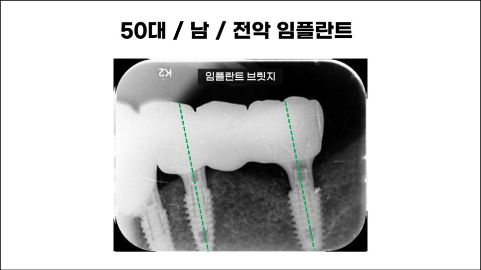전체임플란트, 치료, 종류, 수술과정과 방법 관련 이미지 2