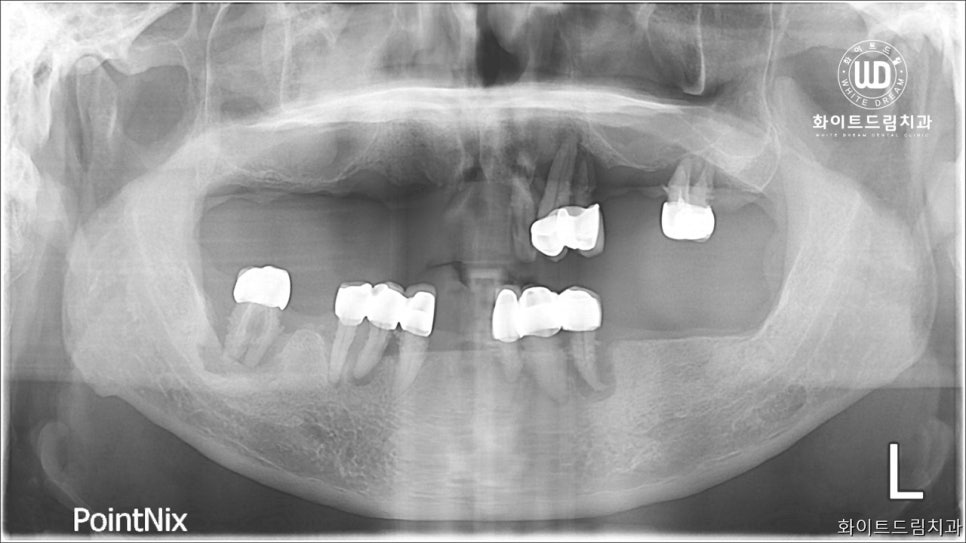 무너진 잇몸뼈와 치아 상실을 대체하는 전악임플란트 치료 사례 관련 이미지 8