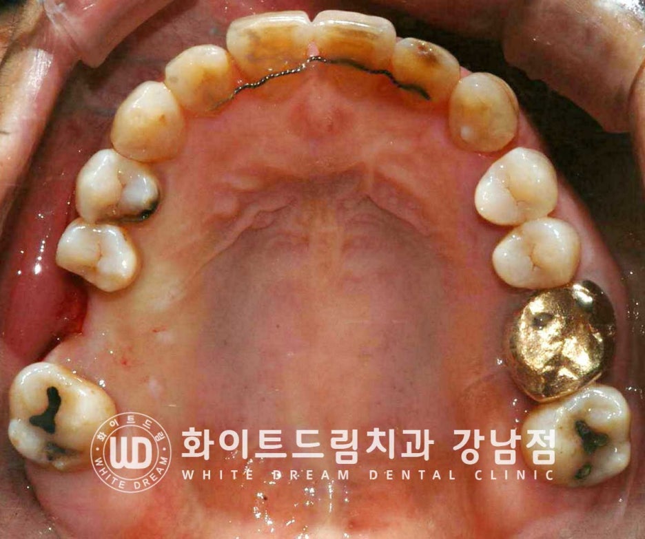 Why You Must Know About "Sinus Lift" Before Upper Molar Implants image 6