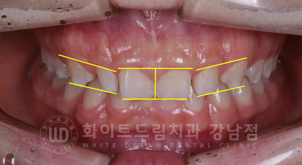 강남역 라미네이트 "치아가 작고 벌어졌어요" 거미스마일 + 벌어진 치아 개선 관련 이미지 7