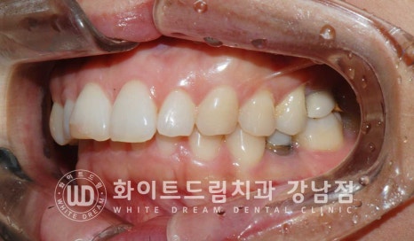 앞니 원데이라미네이트, 뻐드러지고 벌어진 앞니! 당일 치료 ok 관련 이미지 11