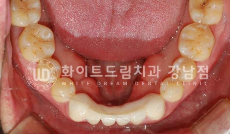 강남역 결손치 "앞니 두 개가 없고, 벌어졌어요" 결손치 치료 방법 관련 이미지 22