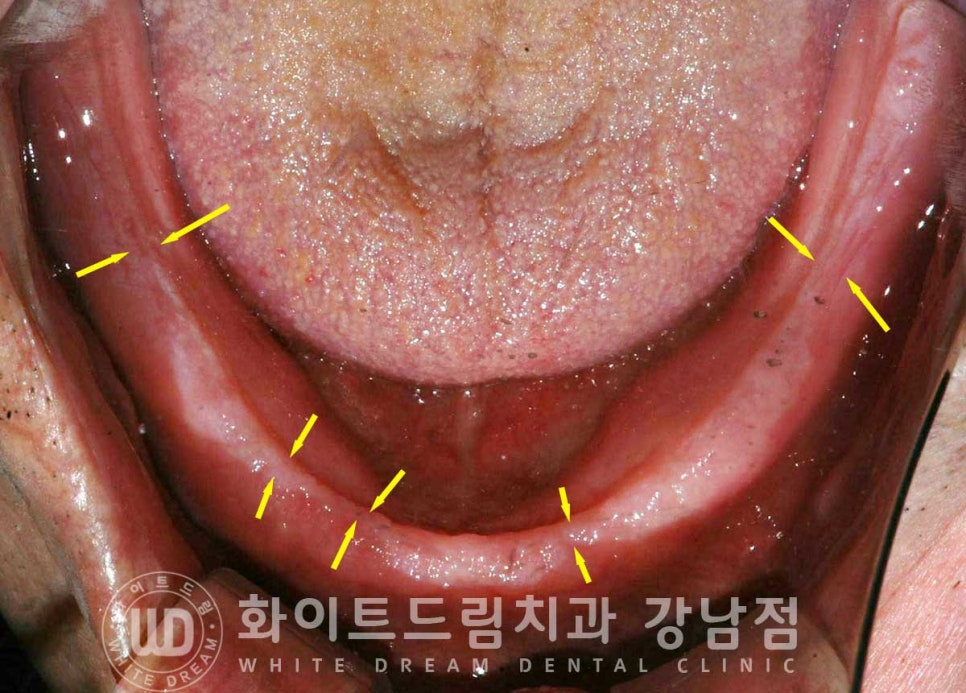 전체 임플란트 치료 기간과 수술 후 나타나는 변화는? 관련 이미지 5