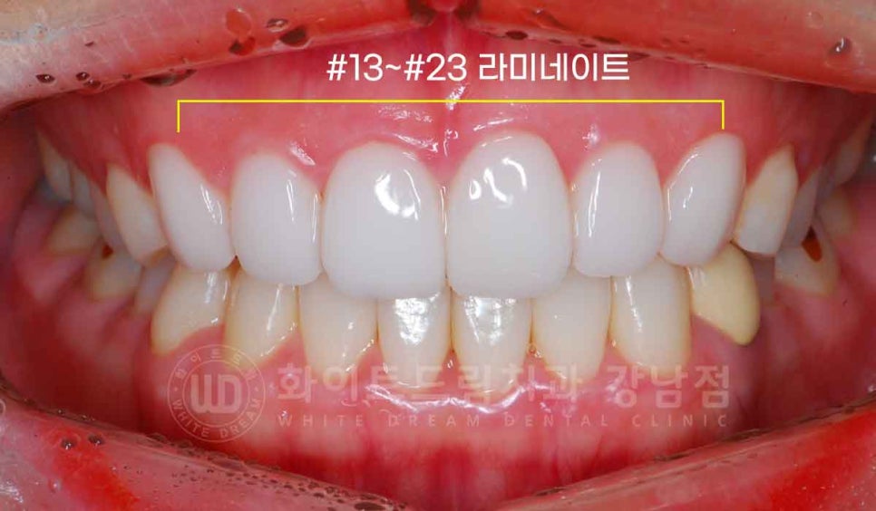 강남역 나비앞니 라미네이트 / "투명교정과 라미네이트 치료" 강남역 화이트드림치과 관련 이미지 10