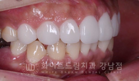 틀어진 치아 라미네이트, 틀어지고 색이 다른 앞니가 고민이에요. 관련 이미지 14