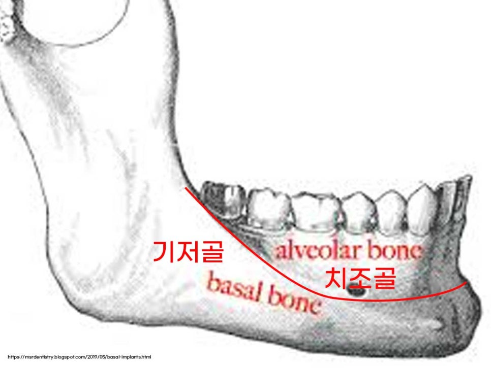 잇몸뼈가 없다는 게 무슨 말일까? "틀니를 오래 사용해서 잇몸뼈가 없대요" 임플란트 잘하는 강남치과 관련 이미지 1