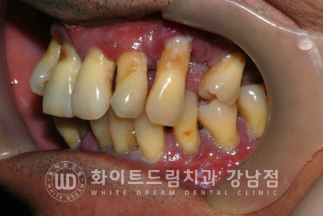 강남역 전악임플란트치과 / 치주 질환이 치아와 임플란트에 끼치는 영향! 관련 이미지 4