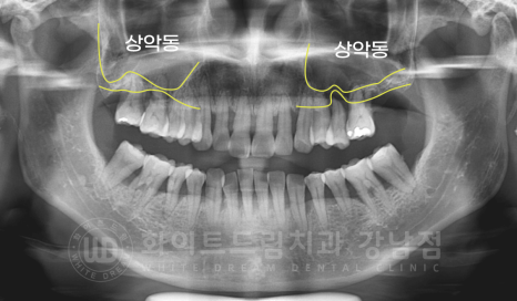 서초동 치과 추천 / "임플란트 개수를 줄이는 식립 방법은?" 강남 화이트드림치과 임플란트 관련 이미지 11
