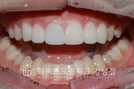 벌어진 앞니라미네이트 / "왜소치로 치아가 벌어졌어요" 치료 사례 관련 이미지 12