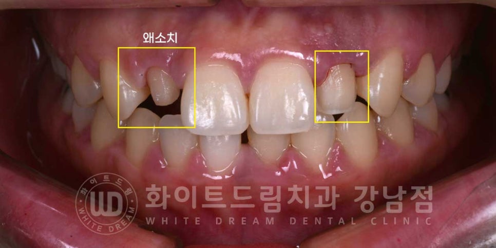 역삼역 왜소치치료 / 치아 하나가 너무 작아요. 왜소치 라미네이트 잘하는 치과 관련 이미지 7