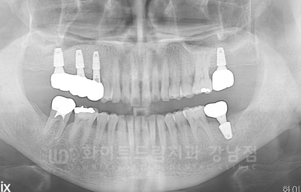 서초동 어금니 임플란트 / 강남역 화이트드림치과 : 상악동 거상술 (crestal approch) 관련 이미지 13