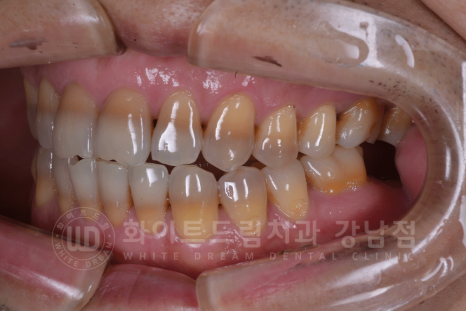 강남역 인근 치과 / 테트라사이클린(tetracycline) 치아 변색 / 라미네이트로 개선! 관련 이미지 3