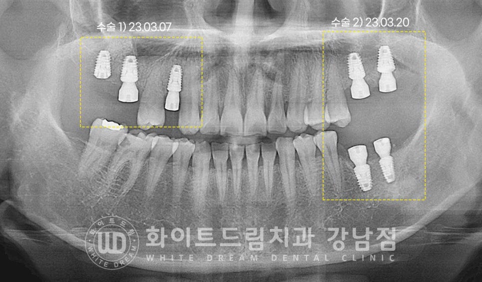 신경치료 후 크라운을 해야 하는 이유 / 크라운을 안 해 부러진 치아 임플란트 치료 case 관련 이미지 16