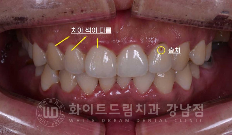 틀어진 치아 라미네이트, 틀어지고 색이 다른 앞니가 고민이에요. 관련 이미지 5