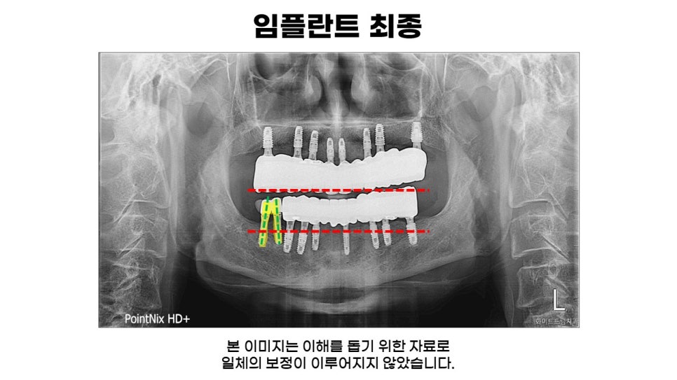 전악 임플란트 과정 및 후기 전후사례확인하고 임플란트가격 비용 알아보기 관련 이미지 4