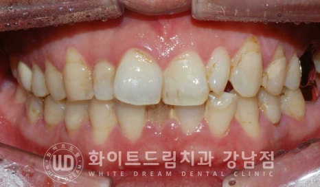 앞니 레진변색 "너무 지저분해 보여요." 라미네이트로 깔끔하게 교체한 치료 사례 관련 이미지 10