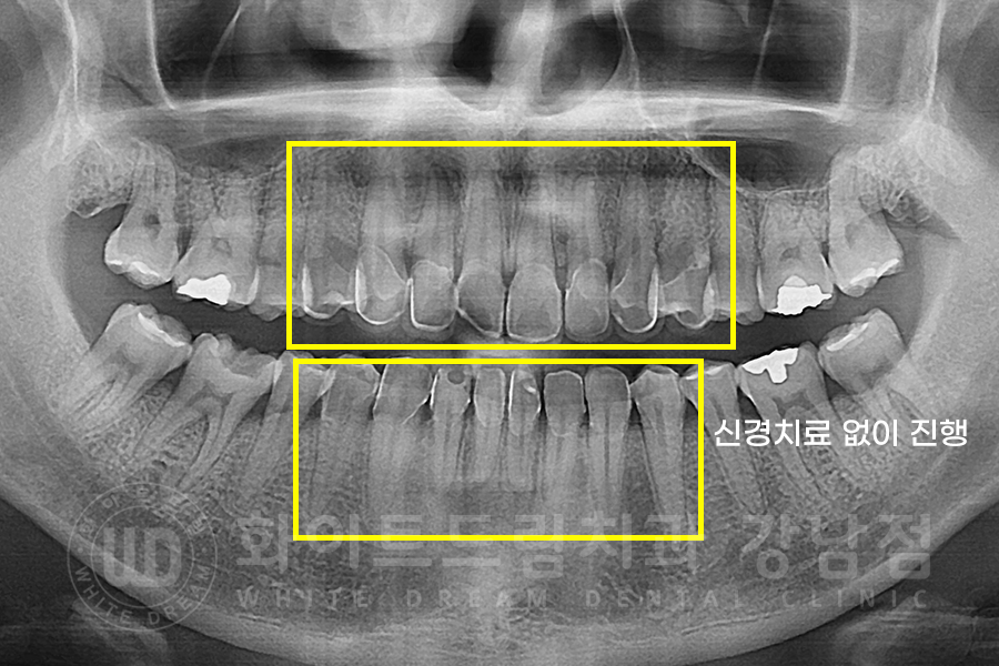 강남역 앞니라미네이트 "틀어진 토끼 앞니 빠르게 개선" 강남역 라미네이트 치과 관련 이미지 3