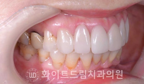 신논현라미네이트, 중년 충치치료, "치경부 우식증, 라미네이트로 당일 치료 OK" 관련 이미지 13