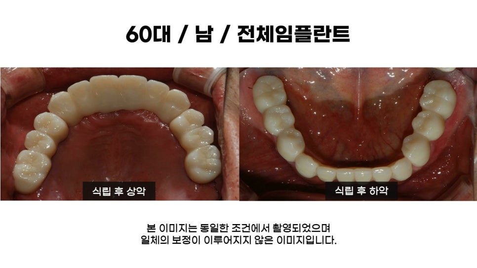 어금니임플란트 수복 및 당뇨환자임플란트 가격, 종류, 통증 관련 이미지 14