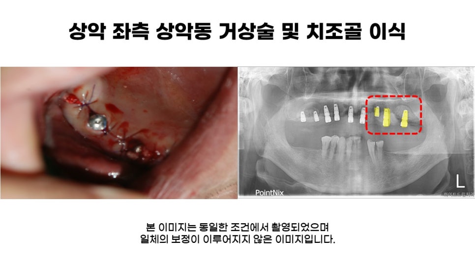 어금니임플란트 수복 및 당뇨환자임플란트 가격, 종류, 통증 관련 이미지 7