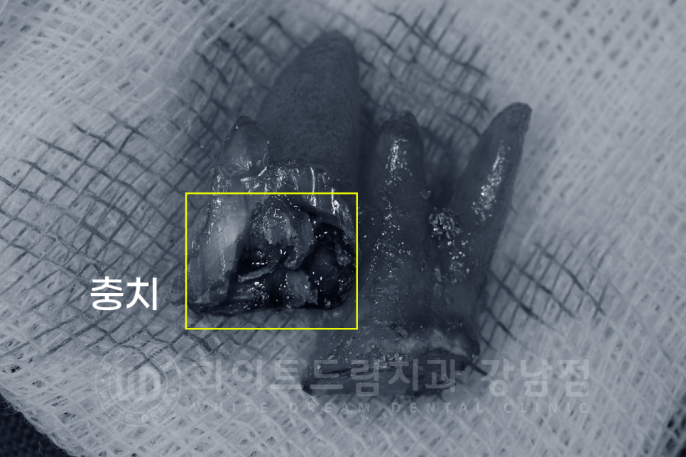 강남역 어금니 임플란트 "어금니가 부러졌어요" 상악동 거상술(lateral approach) 관련 이미지 4