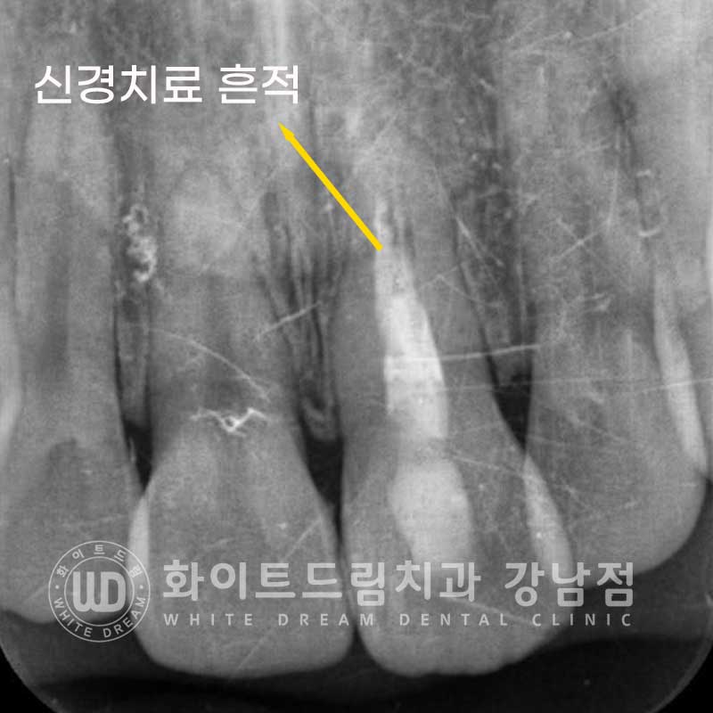 신경치료 후 변색된치아, 라미네이트로 변색과 모양까지 개선! / 강남역화이트드림치과 관련 이미지 6