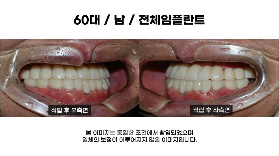 어금니임플란트 수복 및 당뇨환자임플란트 가격, 종류, 통증 관련 이미지 13