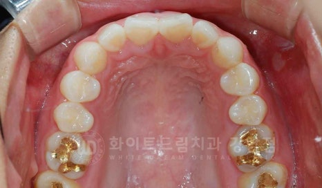 강남역 나비앞니 라미네이트 / "투명교정과 라미네이트 치료" 강남역 화이트드림치과 관련 이미지 17
