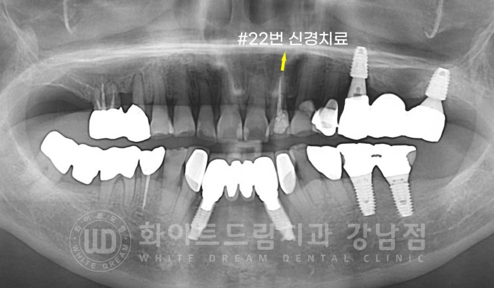 중년 앞니라미네이트 / 노화로 마모되고 누렇게 변한 치아, 어떻게 치료할까? 관련 이미지 10
