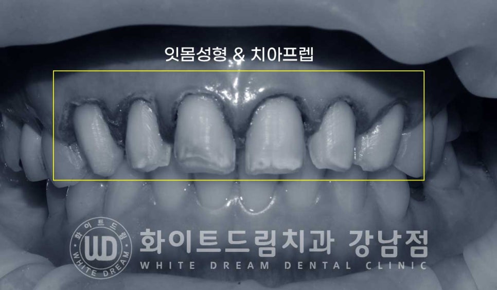 앞니 원데이라미네이트 / 떨어진 앞니 레진 & 벌어진 앞니, 라미네이트로 당일 개선 ★ 관련 이미지 6