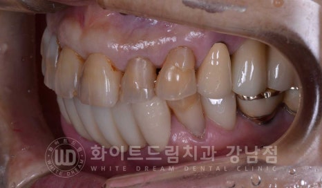 중년 앞니라미네이트 / 노화로 마모되고 누렇게 변한 치아, 어떻게 치료할까? 관련 이미지 6