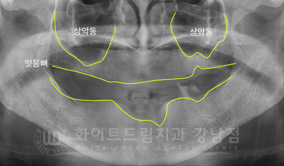 서울 전체임플란트 기간 / 전체 임플란트 7개월 완성, 무치악 임플란트 관련 이미지 6