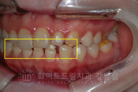 법랑질형성부전증, 라미네이트로 개선해요! / 강남역 라미네이트 치과 관련 이미지 4