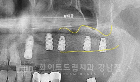 임플란트 재수술의 주원인, "임플란트 주위염과 임플란트 찢어짐!" 관련 이미지 14