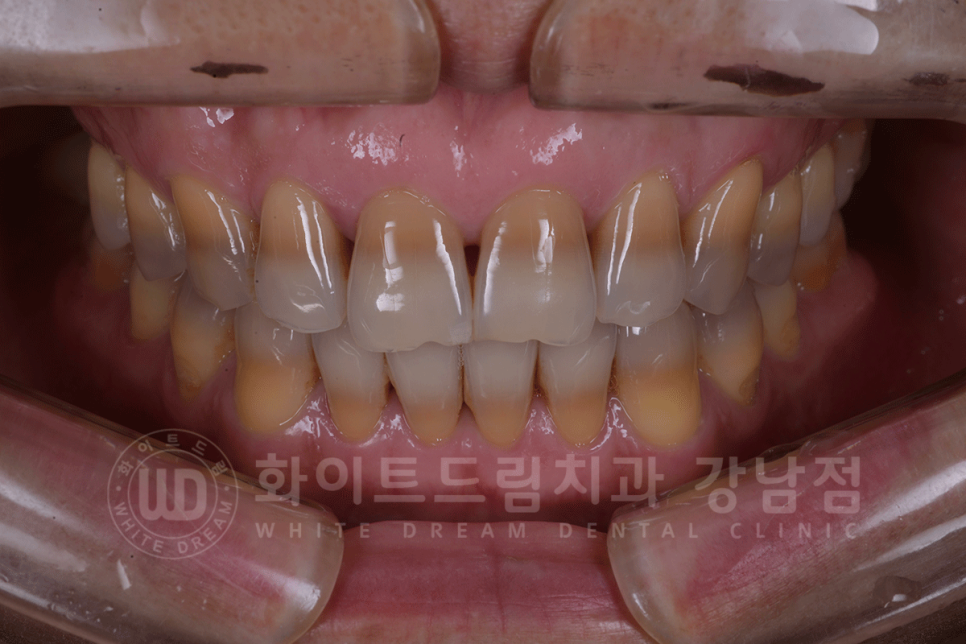 강남역 인근 치과 / 테트라사이클린(tetracycline) 치아 변색 / 라미네이트로 개선! 관련 이미지 2