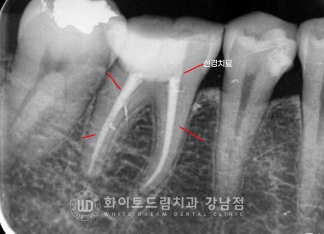 신경치료 후 크라운을 해야 하는 이유 / 크라운을 안 해 부러진 치아 임플란트 치료 case 관련 이미지 11