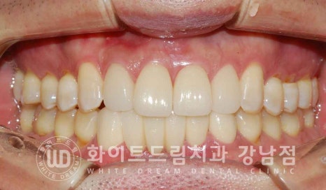 강남역 결손치 "앞니 두 개가 없고, 벌어졌어요" 결손치 치료 방법 관련 이미지 18
